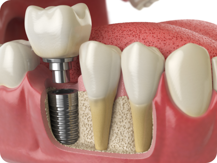 anatomy of healthy teeth and tooth dental implant P5PWYZQ